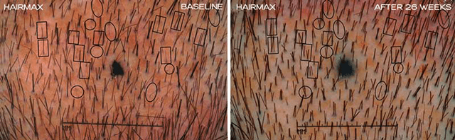 HairMax-clinical-study-photos-showing-new-hair-growth