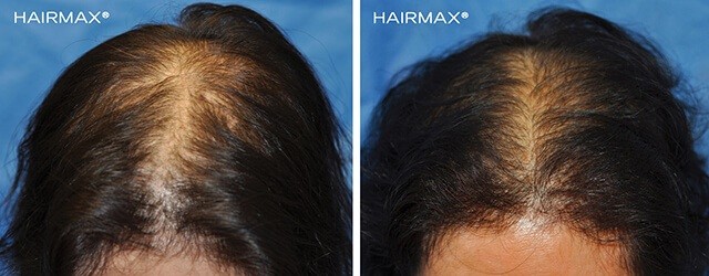 Hairmax before after female4