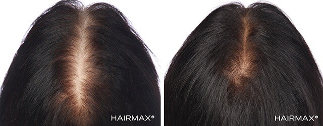 Hairmax before after female2