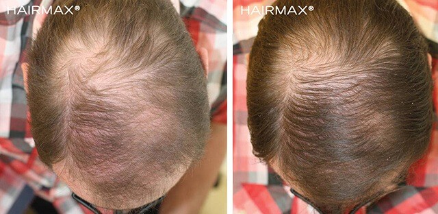 Hairmax before after male2