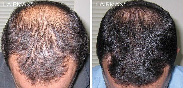 Hairmax before after male24