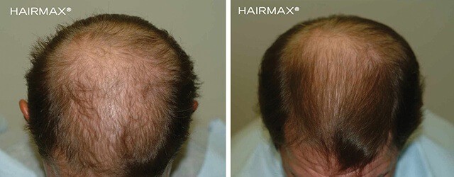 Hairmax before after male4